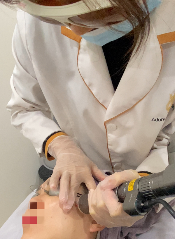 Laser-Hollywood Laser Toning