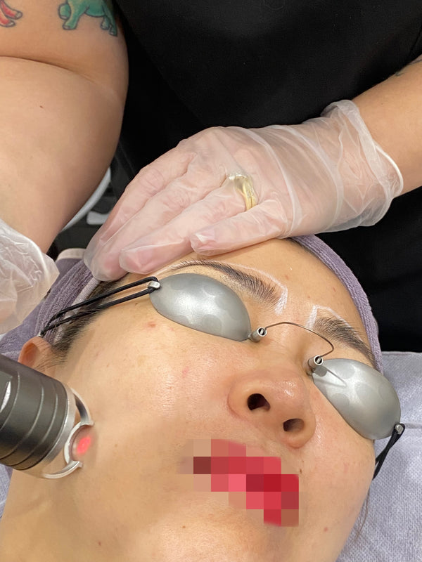 Laser-MLA Fractional Resurfacing